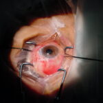 Benefits of Cataract Surgery for Seniors