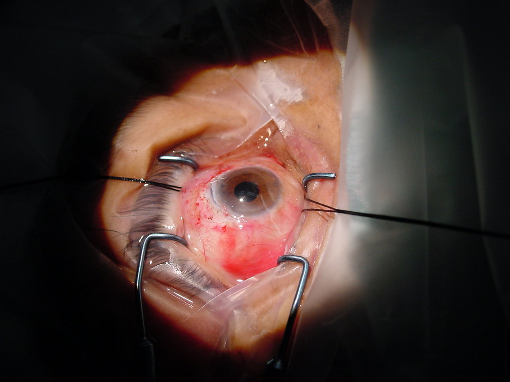Benefits of Cataract Surgery for Seniors