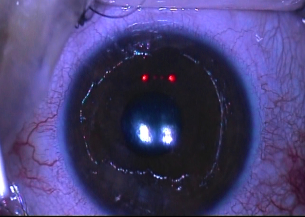 Corneal Cross Linking for Keratoconus