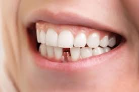 How Dental Implants Integrate with Natural Teeth for Seamless Results