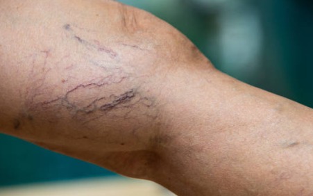 How to Recognize and Manage Varicose Veins Early
