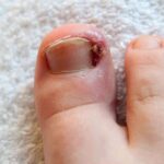 How to Spot and Treat an Ingrown Toenail Early
