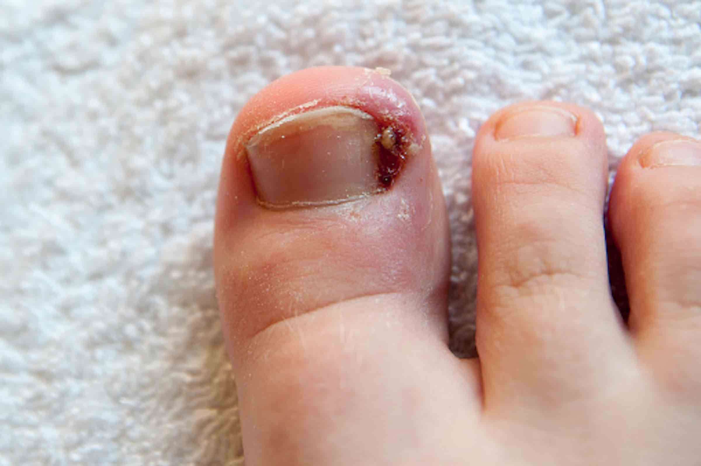 How to Spot and Treat an Ingrown Toenail Early