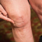 Joint Replacement: How to Prepare for Surgery