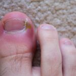 Preventing Ingrown Toenails: Tips for Proper Foot Care