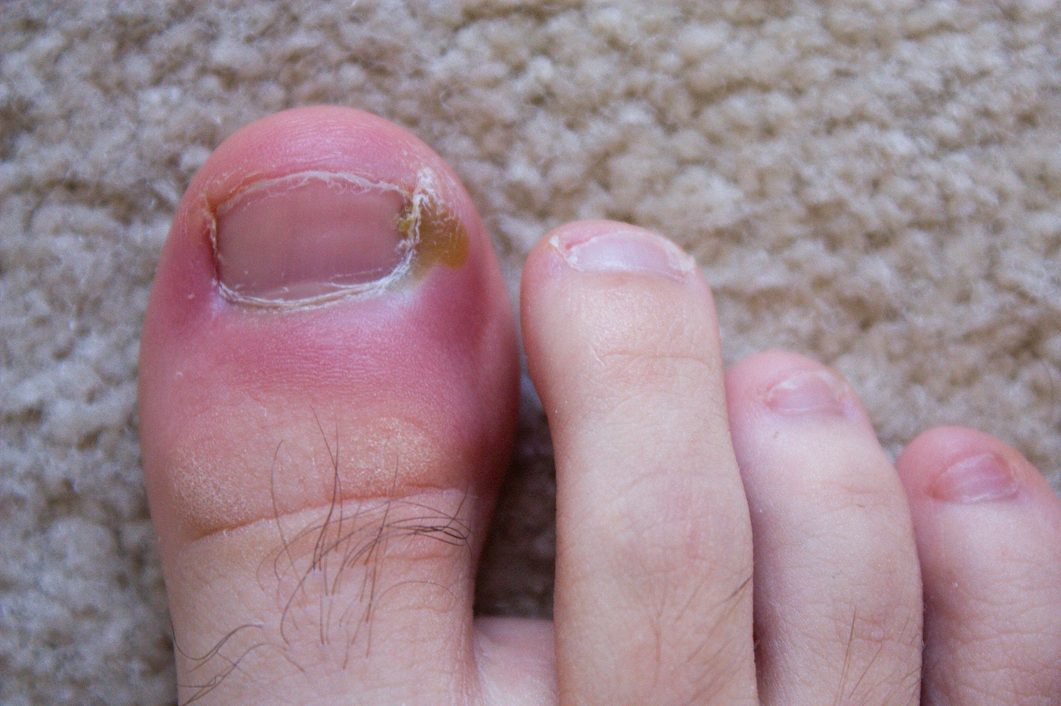 Preventing Ingrown Toenails: Tips for Proper Foot Care