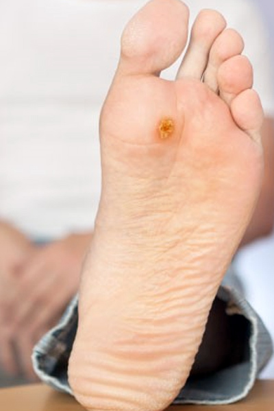 Steps to Prevent Warts from Developing on Your Feet
