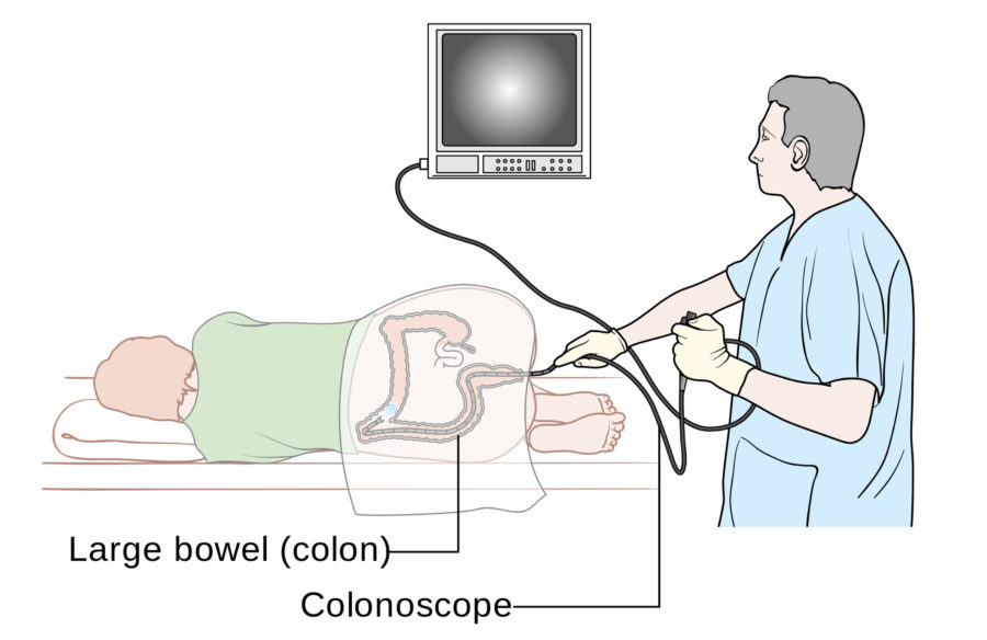 The Role of Colonoscopy in Preventing Colon Cancer