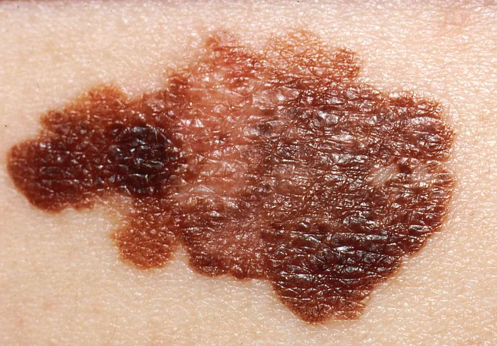 The Role of Genetics in Skin Cancer Development