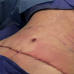 Tummy Tuck, Liposuction, and Pregnancy