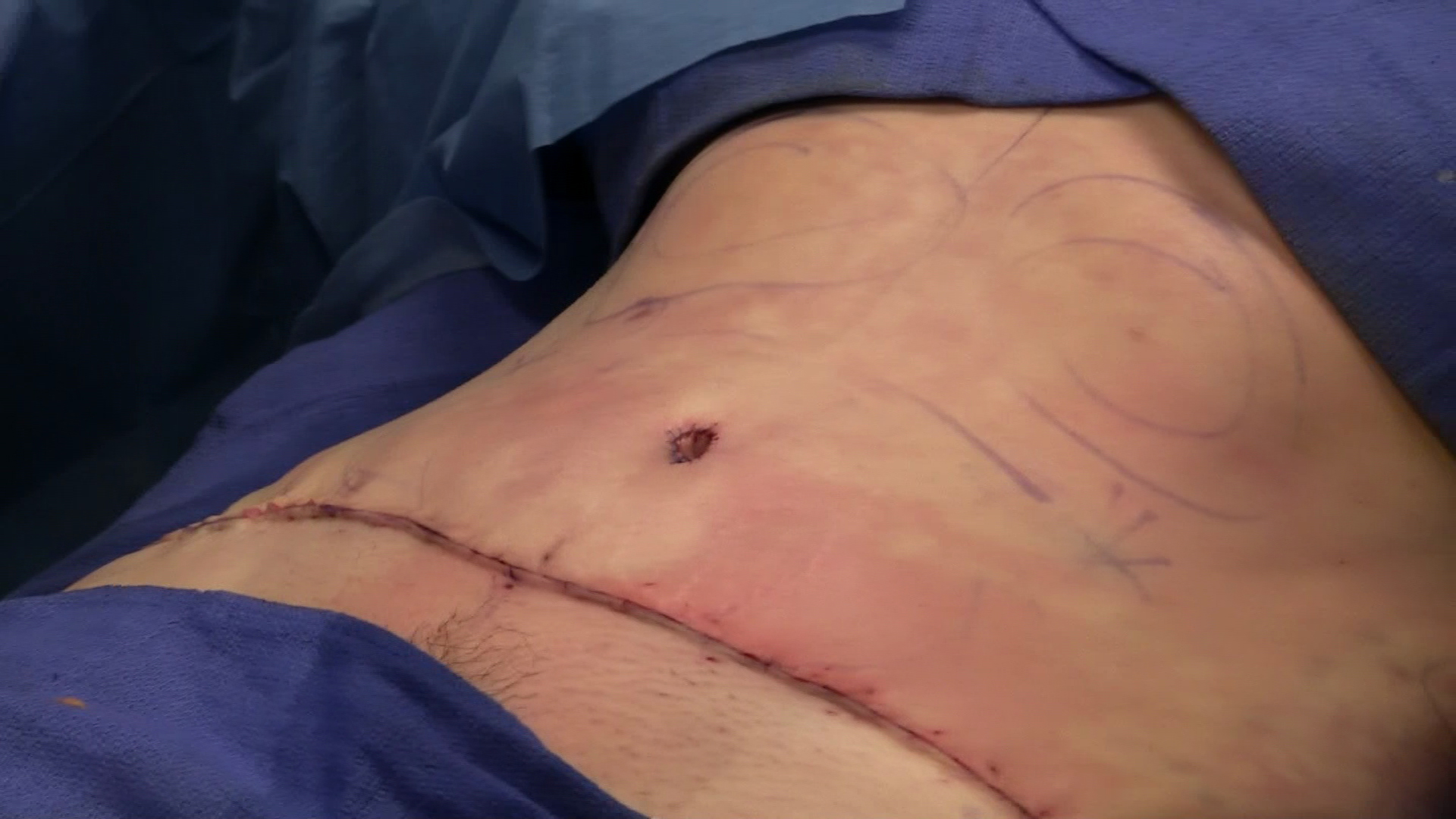 Tummy Tuck, Liposuction, and Pregnancy
