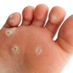What Causes Bunions?