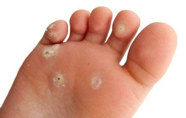 What Causes Bunions?