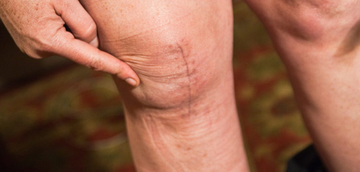 What Causes Varicose Veins and How Can You Prevent Them?