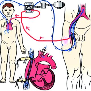 What Parents Need to Know About Gallbladder Surgery for Children