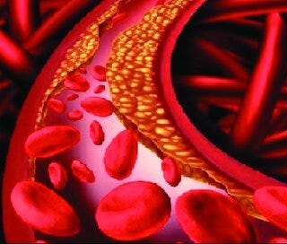 What Vascular Disease Means for Your Blood Flow and How to Improve It