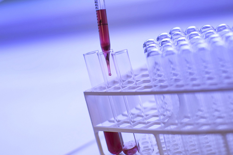 What is a PSA test in detecting Prostate Cancer?