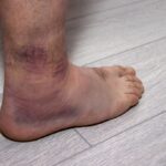 When to See a Doctor for a Sprained Ankle