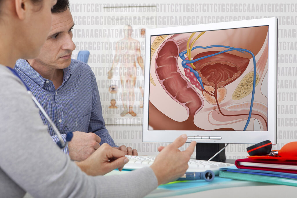 How To Treat Prostate Cancer
