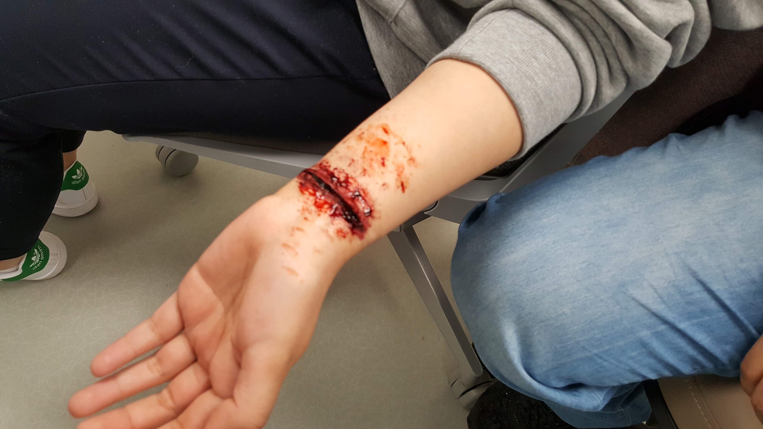 How to Know When a Wound Needs Medical Attention