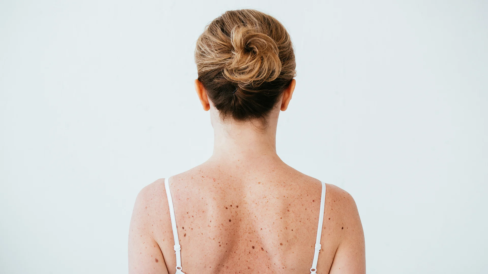 How to Manage a Skin Cancer Diagnosis