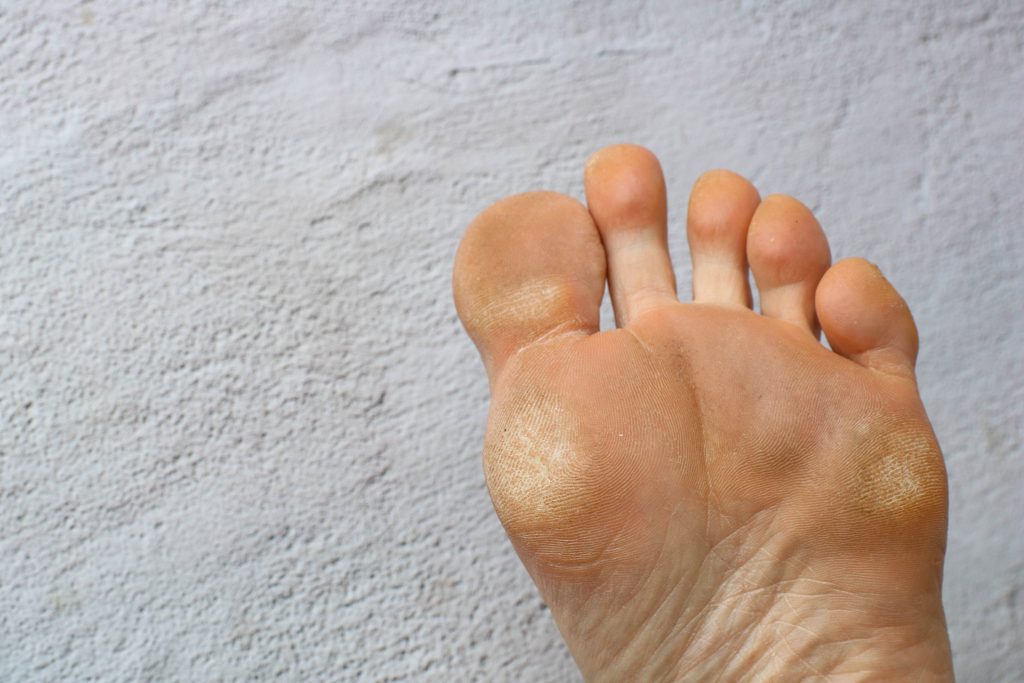 How to Treat Common Foot Issues in Diabetic Patients