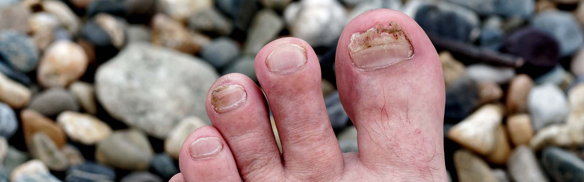 Is it Time to Seek Professional Help for an Ingrown Toenail?