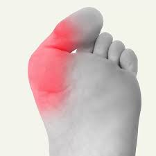 Nonsurgical Versus Surgical Options for Bunions
