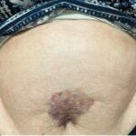 Perianal Abscesses: Prevention, Symptoms, and Treatment
