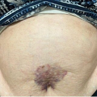 Perianal Abscesses: Prevention, Symptoms, and Treatment