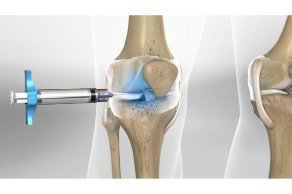 What Happens During a Knee Replacement Surgery?