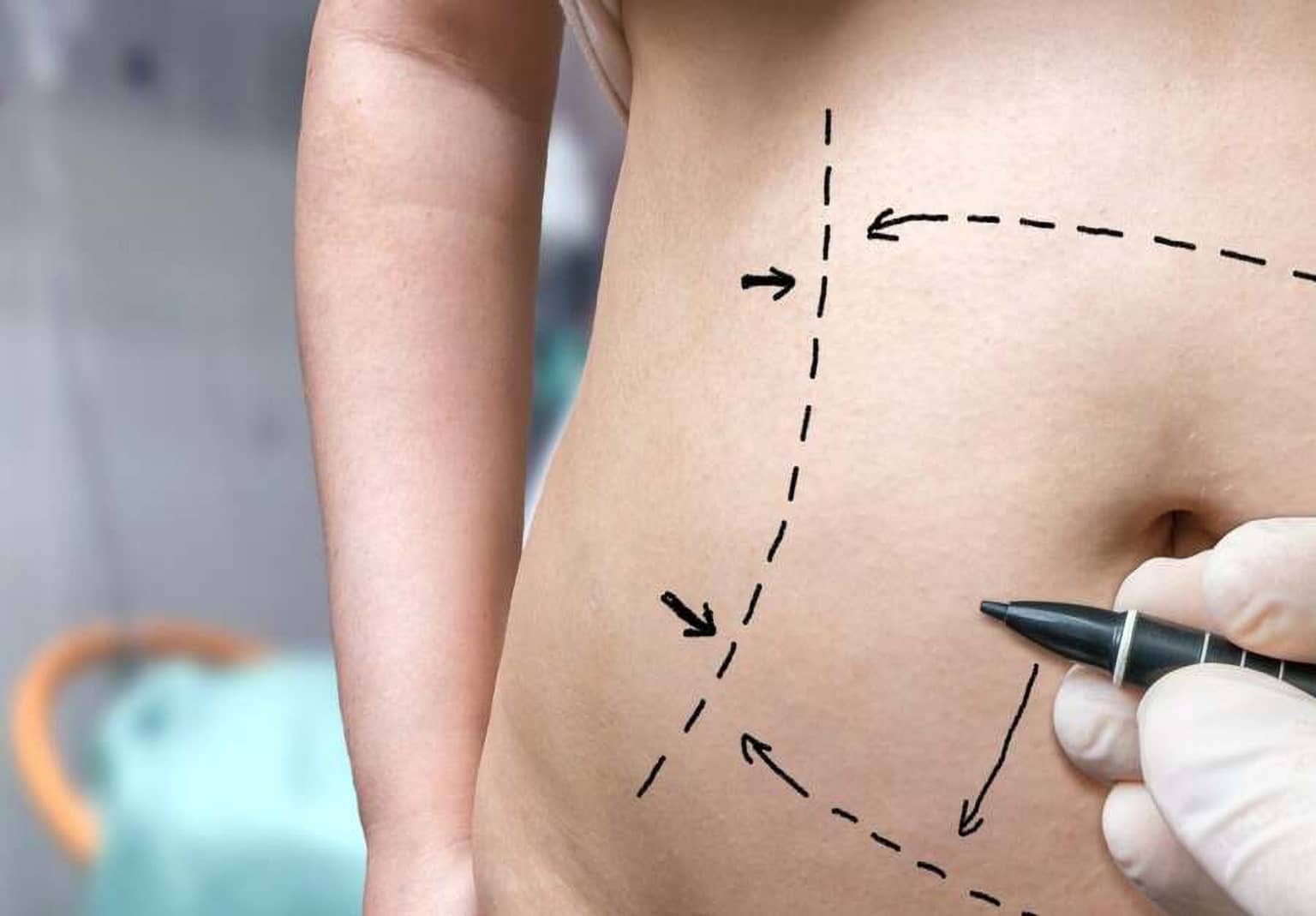 What To Expect During the Tummy Tuck Recovery Process