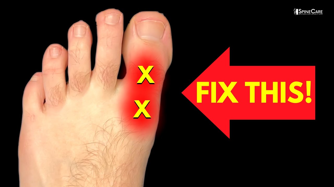 What You Should Know About Bunions Before Seeking Treatment