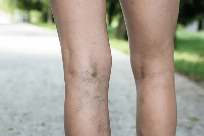 Identifying and Treating Spider Veins