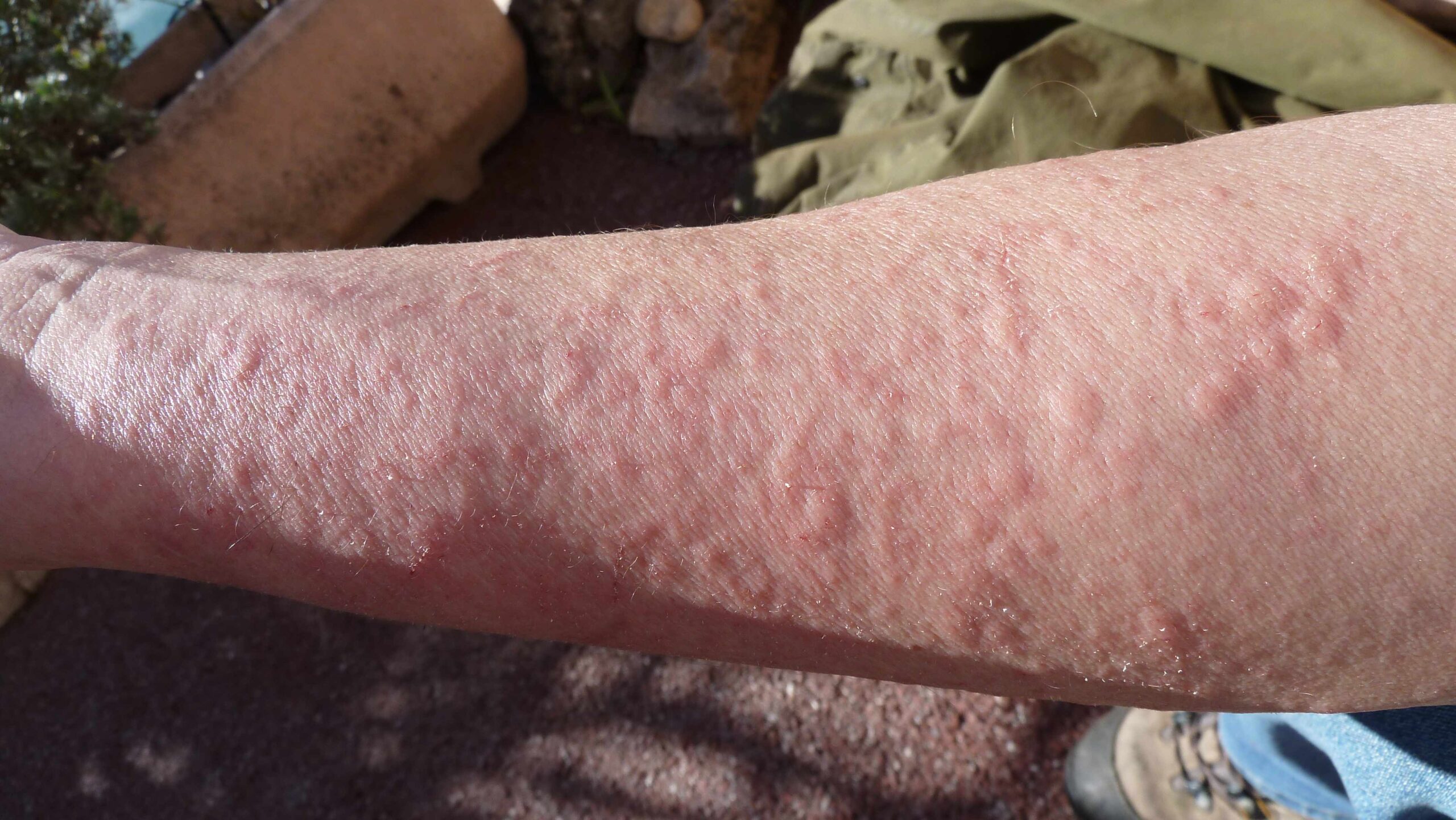 The Connection Between Hives and Allergic Reactions