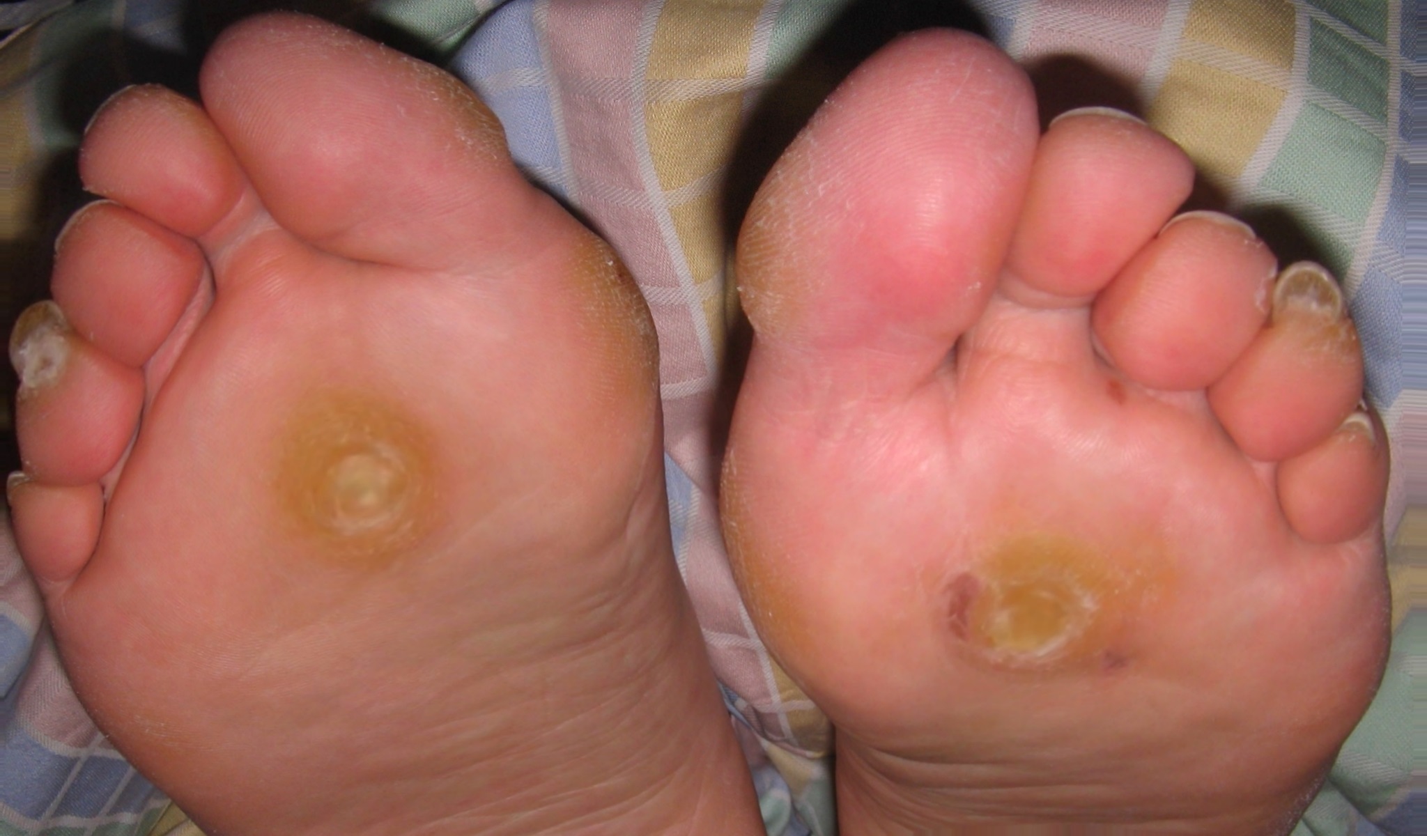 The Different Types of Plantar Warts and How to Treat Them
